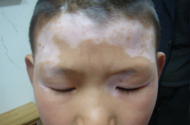 武汉儿童刚开始患上白癜风的时候会有哪些症状呢?