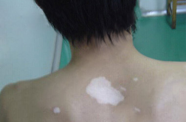 武汉男性背部患有白癜风怎么治疗?