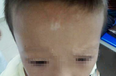 武汉北大白癜风医院介绍哪些做法不利于儿童白斑治疗呢?