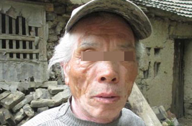 武汉北大白癜风医院告诉您老年人为什么会得白癜风呢?