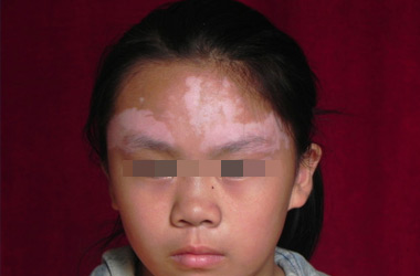 武汉北大白癜风医院介绍脸部有哪些症状会是白癜风?