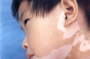 武汉北大白癜风医院讲解怎么护理儿童白癜风患者的心理呢?